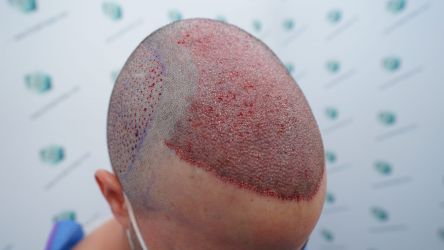 Injerto Capilar Técnica FUE Grafts 3589 (9178 Pelos) 26 31 TRASPLANTE CAPILAR