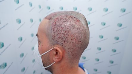 Injerto Capilar Técnica FUE Grafts 3589 (9178 Pelos) 29 34 TRASPLANTE CAPILAR