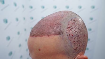 Injerto Capilar Técnica FUE Grafts 3589 (9178 Pelos) 31 36 TRASPLANTE CAPILAR