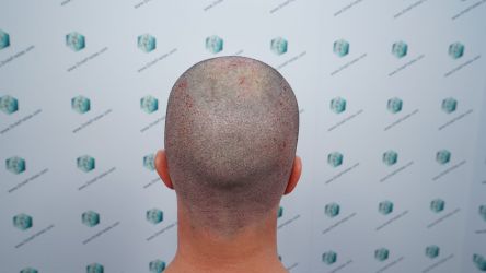 Injerto Capilar Técnica FUE Grafts 3589 (9178 Pelos) 32 37 TRASPLANTE CAPILAR