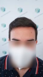 Injerto Capilar Técnica FUE Grafts 3589 (9178 Pelos) 33 38 RESULTADOS A LOS 12 MESES