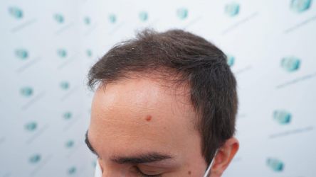 Injerto Capilar Técnica FUE Grafts 3589 (9178 Pelos) 3 4 ANTES DEL TRASPLANTE CAPILAR