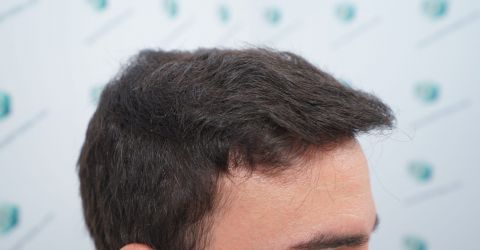Injerto Capilar Técnica FUE Grafts 3589 (9178 Pelos) 34 40 RESULTADOS A LOS 12 MESES