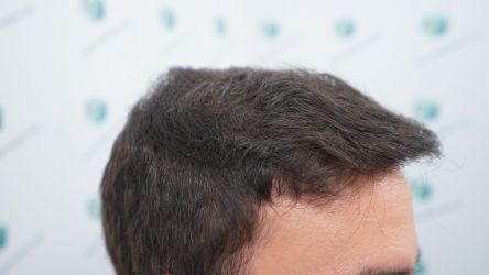 Injerto Capilar Técnica FUE Grafts 3589 (9178 Pelos) 35 41 RESULTADOS A LOS 12 MESES