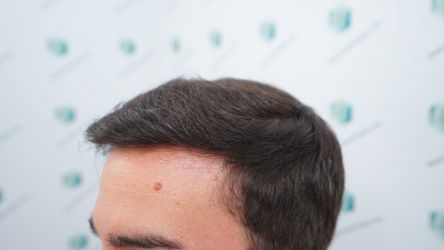 Injerto Capilar Técnica FUE Grafts 3589 (9178 Pelos) 36 42 RESULTADOS A LOS 12 MESES