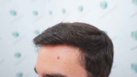 Injerto Capilar Técnica FUE Grafts 3589 (9178 Pelos) 37 43 RESULTADOS A LOS 12 MESES