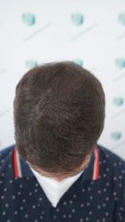 Injerto Capilar Técnica FUE Grafts 3589 (9178 Pelos) 38 44 RESULTADOS A LOS 12 MESES