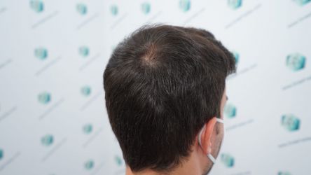 Injerto Capilar Técnica FUE Grafts 3589 (9178 Pelos) 41 47 RESULTADOS A LOS 12 MESES