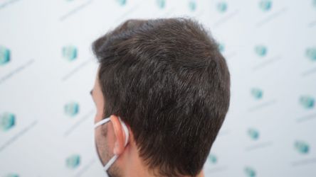Injerto Capilar Técnica FUE Grafts 3589 (9178 Pelos) 42 48 RESULTADOS A LOS 12 MESES