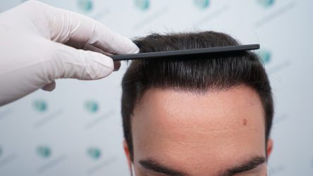 Injerto Capilar Técnica FUE Grafts 3589 (9178 Pelos) 43 49 RESULTADOS A LOS 12 MESES