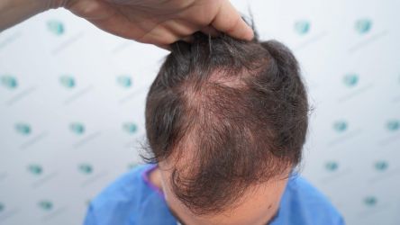 Injerto Capilar Técnica FUE Grafts 3589 (9178 Pelos) 4 5 ANTES DEL TRASPLANTE CAPILAR