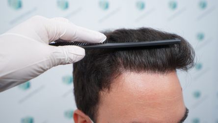 Injerto Capilar Técnica FUE Grafts 3589 (9178 Pelos) 44 51 RESULTADOS A LOS 12 MESES