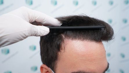 Injerto Capilar Técnica FUE Grafts 3589 (9178 Pelos) 45 52 RESULTADOS A LOS 12 MESES