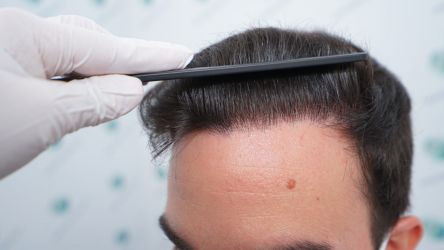 Injerto Capilar Técnica FUE Grafts 3589 (9178 Pelos) 46 53 RESULTADOS A LOS 12 MESES