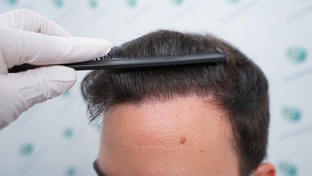 Injerto Capilar Técnica FUE Grafts 3589 (9178 Pelos) 47 54 RESULTADOS A LOS 12 MESES