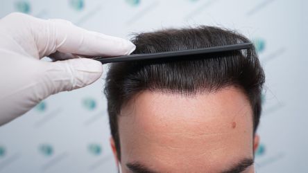 Injerto Capilar Técnica FUE Grafts 3589 (9178 Pelos) 48 55 RESULTADOS A LOS 12 MESES