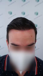 Injerto Capilar Técnica FUE Grafts 3589 (9178 Pelos) 49 56 RESULTADOS A LOS 12 MESES