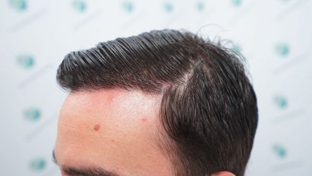 Injerto Capilar Técnica FUE Grafts 3589 (9178 Pelos) 53 59 RESULTADOS A LOS 12 MESES