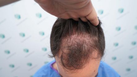 Injerto Capilar Técnica FUE Grafts 3589 (9178 Pelos) 5 6 ANTES DEL TRASPLANTE CAPILAR