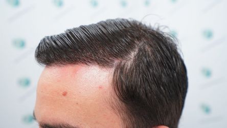 Injerto Capilar Técnica FUE Grafts 3589 (9178 Pelos) 54 60 RESULTADOS A LOS 12 MESES