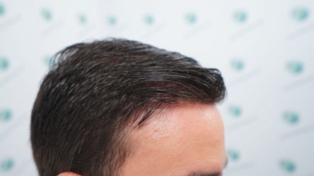 Injerto Capilar Técnica FUE Grafts 3589 (9178 Pelos) 55 61 RESULTADOS A LOS 12 MESES