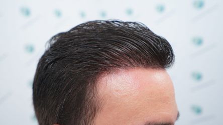 Injerto Capilar Técnica FUE Grafts 3589 (9178 Pelos) 56 62 RESULTADOS A LOS 12 MESES