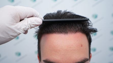 Injerto Capilar Técnica FUE Grafts 3589 (9178 Pelos) 57 64AB RESULTADOS A LOS 12 MESES