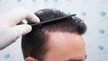 Injerto Capilar Técnica FUE Grafts 3589 (9178 Pelos) 58 65 RESULTADOS A LOS 12 MESES