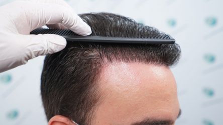 Injerto Capilar Técnica FUE Grafts 3589 (9178 Pelos) 59 67 RESULTADOS A LOS 12 MESES