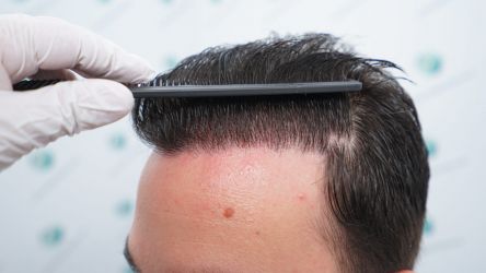 Injerto Capilar Técnica FUE Grafts 3589 (9178 Pelos) 60 68 RESULTADOS A LOS 12 MESES