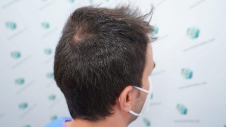 Injerto Capilar Técnica FUE Grafts 3589 (9178 Pelos) 6 7 ANTES DEL TRASPLANTE CAPILAR