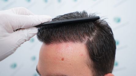 Injerto Capilar Técnica FUE Grafts 3589 (9178 Pelos) 61 70 RESULTADOS A LOS 12 MESES