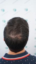 Injerto Capilar Técnica FUE Grafts 3589 (9178 Pelos) 63 72 RESULTADOS A LOS 12 MESES