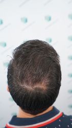 Injerto Capilar Técnica FUE Grafts 3589 (9178 Pelos) 64 73 RESULTADOS A LOS 12 MESES