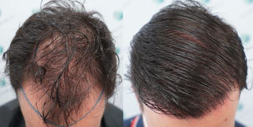 Injerto Capilar Técnica FUE Grafts 3589 (9178 Pelos) 65 75 COMPARATIVAS