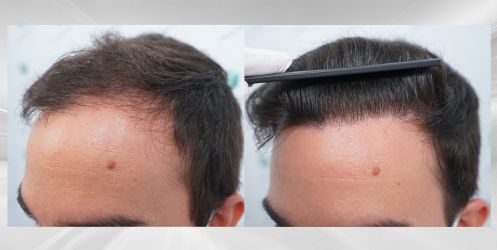 Injerto Capilar Técnica FUE Grafts 3589 (9178 Pelos) 66 76 COMPARATIVAS
