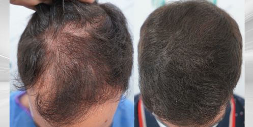 Injerto Capilar Técnica FUE Grafts 3589 (9178 Pelos) 67 78 COMPARATIVAS