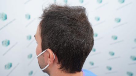 Injerto Capilar Técnica FUE Grafts 3589 (9178 Pelos) 7 8 ANTES DEL TRASPLANTE CAPILAR