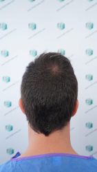 Injerto Capilar Técnica FUE Grafts 3589 (9178 Pelos) 8 9 ANTES DEL TRASPLANTE CAPILAR