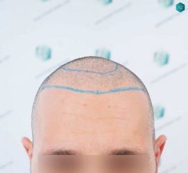 Injerto Capilar Técnica FUE Grafts 2669 (6813 Pelos) 13 10 DISENO LINEA TRASPLANTE DE PELO