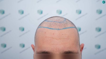 Injerto Capilar Técnica FUE Grafts 2669 (6813 Pelos) 12 11 DISENO LINEA TRASPLANTE DE PELO