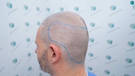 Injerto Capilar Técnica FUE Grafts 2669 (6813 Pelos) 15 11B DISENO LINEA TRASPLANTE DE PELO