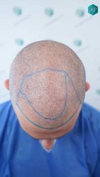 Injerto Capilar Técnica FUE Grafts 2669 (6813 Pelos) 11 12 DISENO LINEA TRASPLANTE DE PELO
