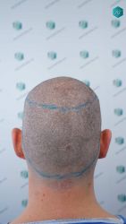 Injerto Capilar Técnica FUE Grafts 2669 (6813 Pelos) 16 13 DISENO LINEA TRASPLANTE DE PELO