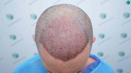 Injerto Capilar Técnica FUE Grafts 2669 (6813 Pelos) 17 14A TRASPLANTE DE PELO