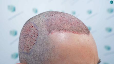 Injerto Capilar Técnica FUE Grafts 2669 (6813 Pelos) 20 16 TRASPLANTE DE PELO