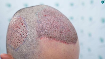 Injerto Capilar Técnica FUE Grafts 2669 (6813 Pelos) 18 16AA TRASPLANTE DE PELO