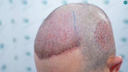 Injerto Capilar Técnica FUE Grafts 2669 (6813 Pelos) 19 16AB TRASPLANTE DE PELO