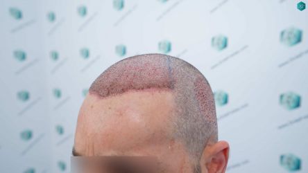 Injerto Capilar Técnica FUE Grafts 2669 (6813 Pelos) 21 17 TRASPLANTE DE PELO