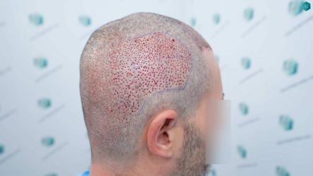 Injerto Capilar Técnica FUE Grafts 2669 (6813 Pelos) 22 18 TRASPLANTE DE PELO